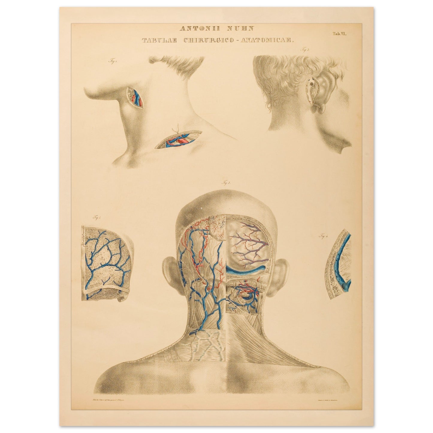 Planche anatomique : Techniques chirurgicales de la région occipitale et mastoïdienne par Anton Nuhn - Taille 30x40 cm