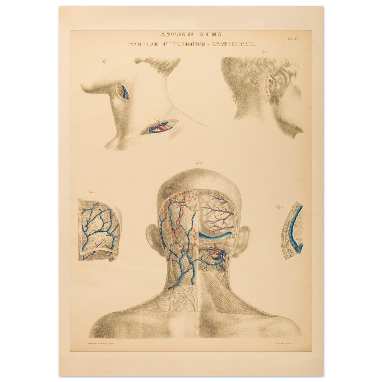 Planche anatomique : Techniques chirurgicales de la région occipitale et mastoïdienne par Anton Nuhn - Taille 50x70 cm