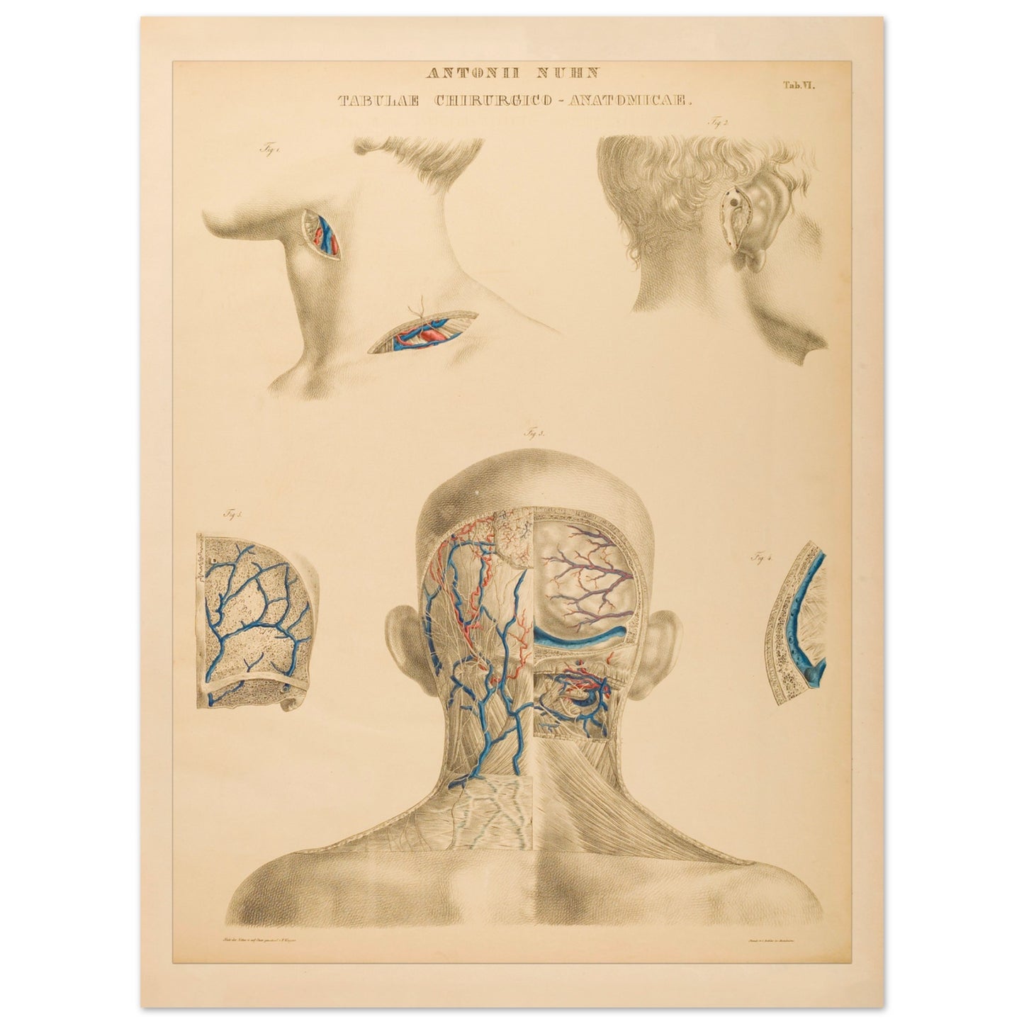 Planche anatomique : Techniques chirurgicales de la région occipitale et mastoïdienne par Anton Nuhn - Taille 60x80 cm