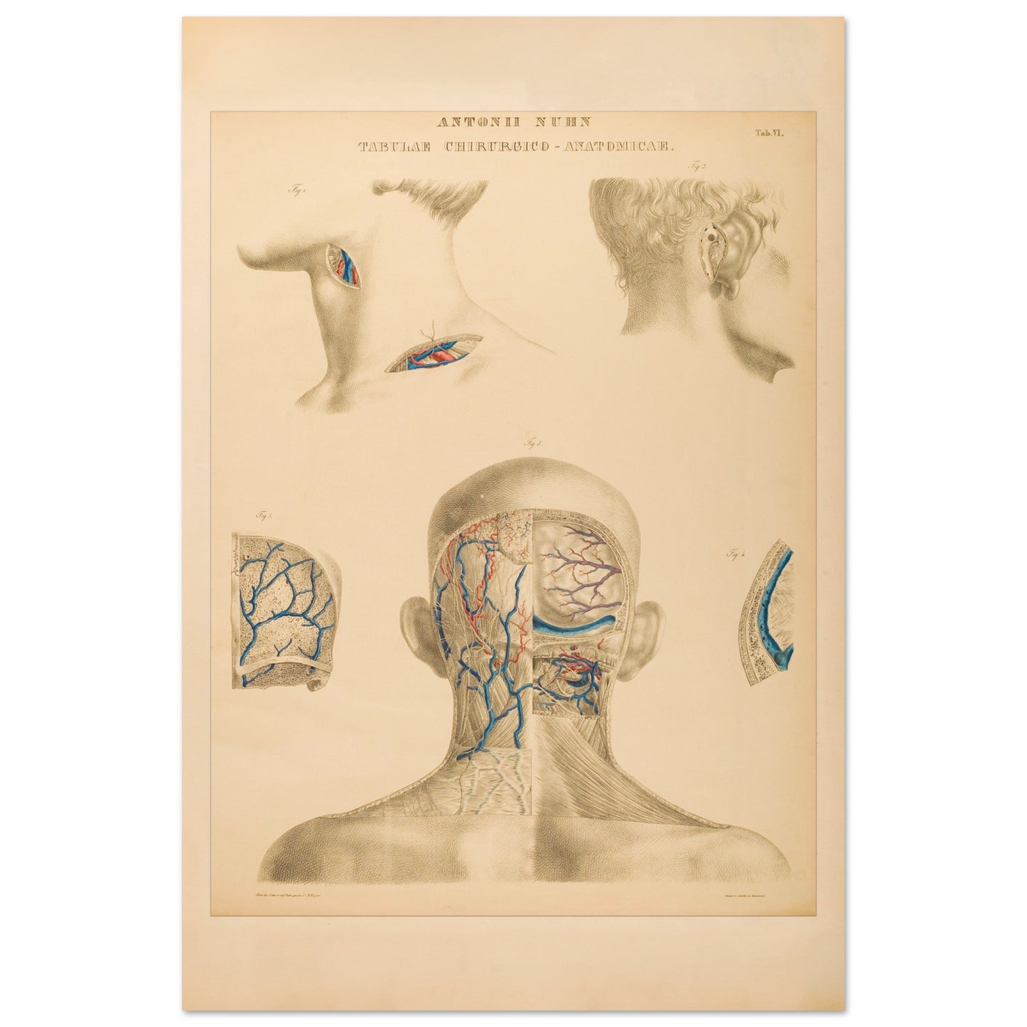 Planche anatomique : Techniques chirurgicales de la région occipitale et mastoïdienne par Anton Nuhn - Taille 60x90 cm