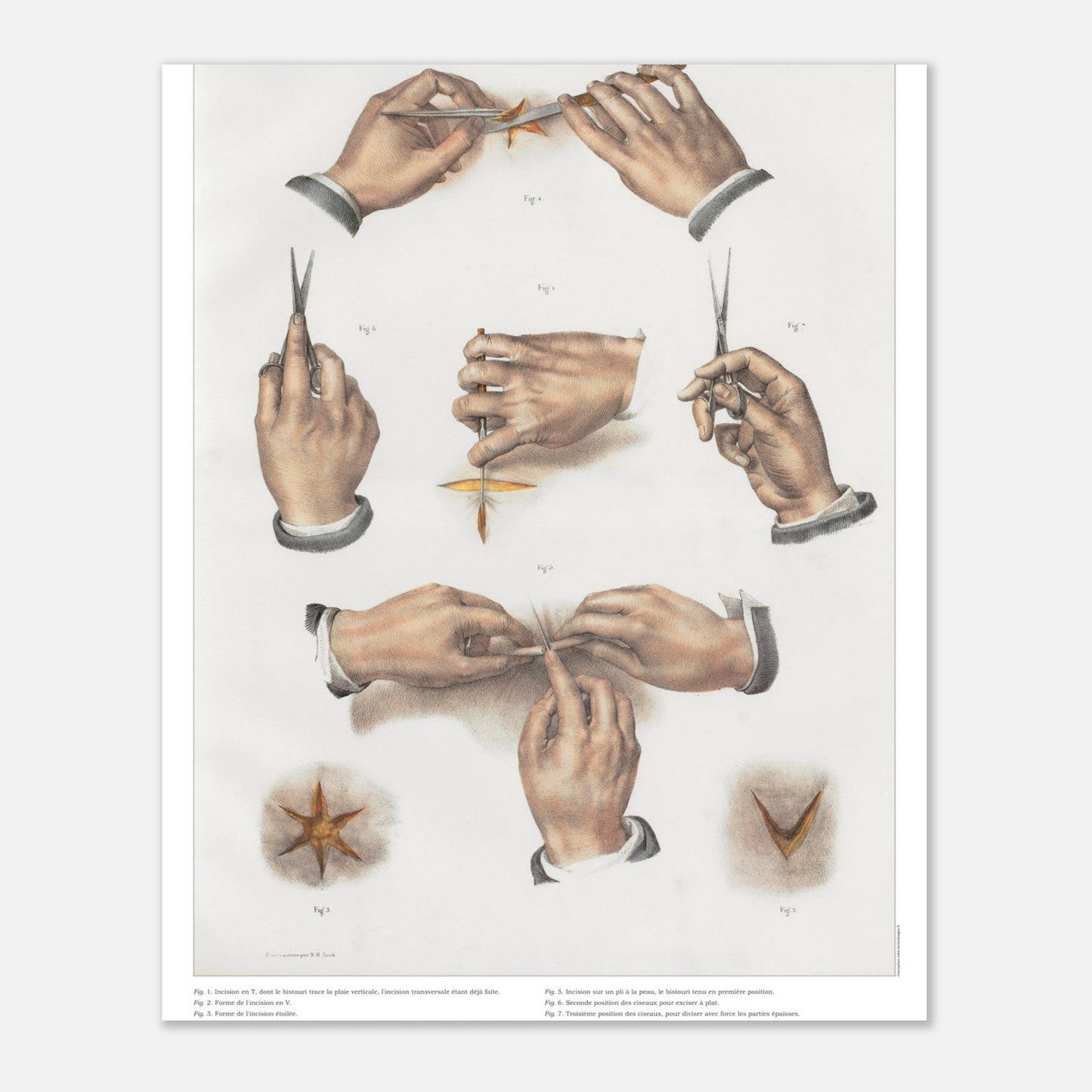 Planche d'anatomie chirurgicale - Incisions et techniques d'excisions - Taille 40x50 cm
