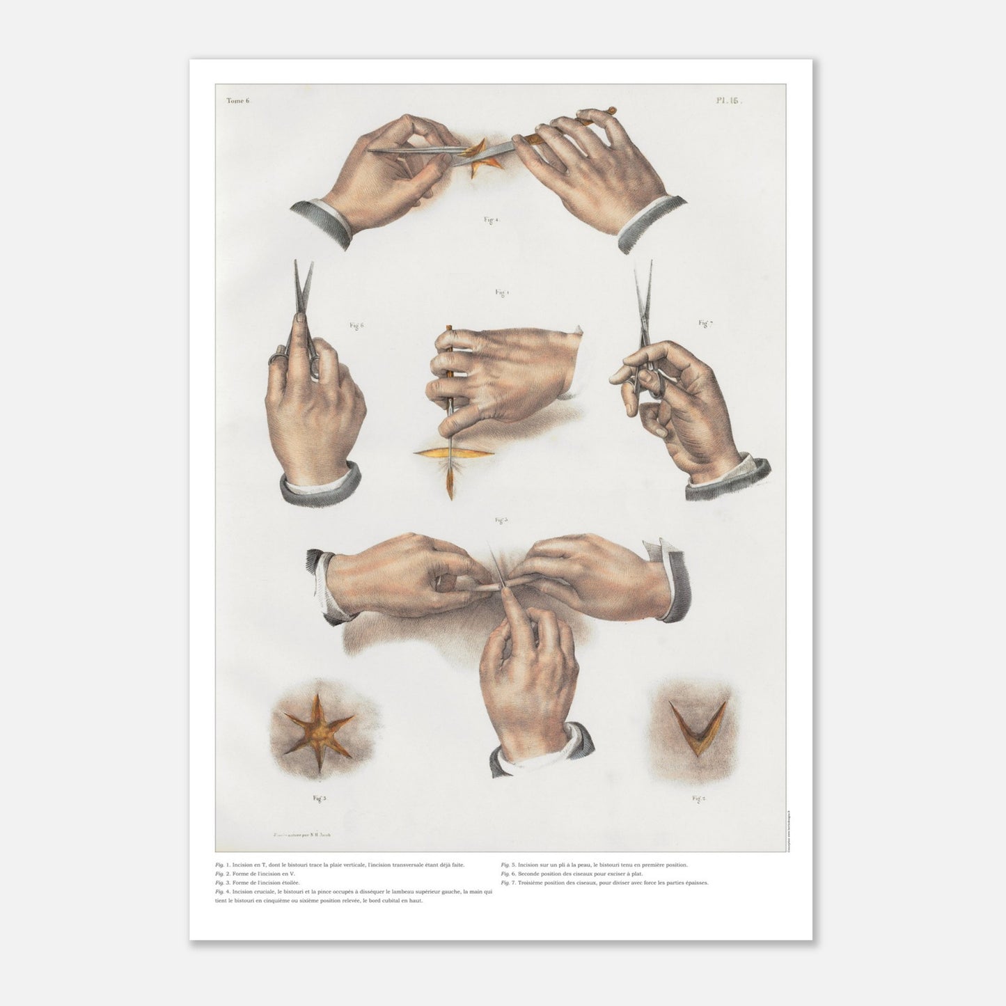 Planche d'anatomie chirurgicale - Incisions et techniques d'excisions - Taille 42x59,4 cm (A2)