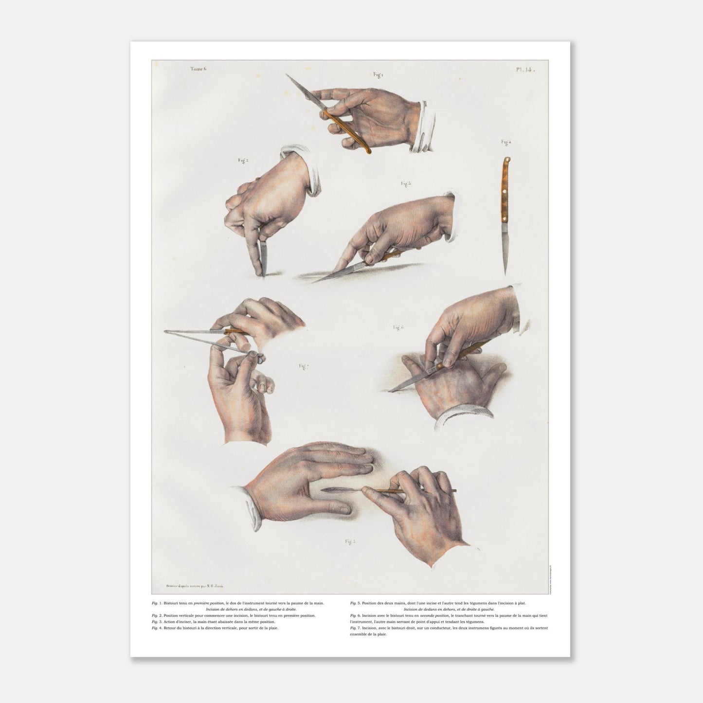 Planche d'anatomie chirurgicale - Position du bistouri et des ciseaux, techniques d'incisions - Taille 50x70 cm