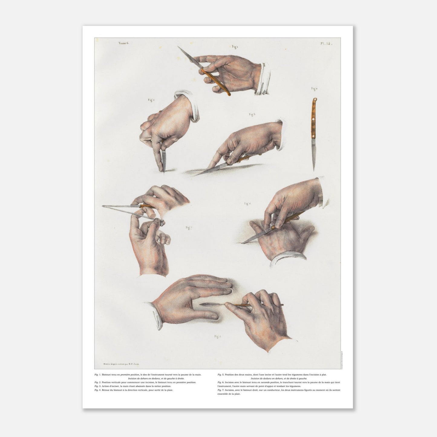Planche d'anatomie chirurgicale - Position du bistouri et des ciseaux, techniques d'incisions - Taille 59,4x84,1 cm (A1)