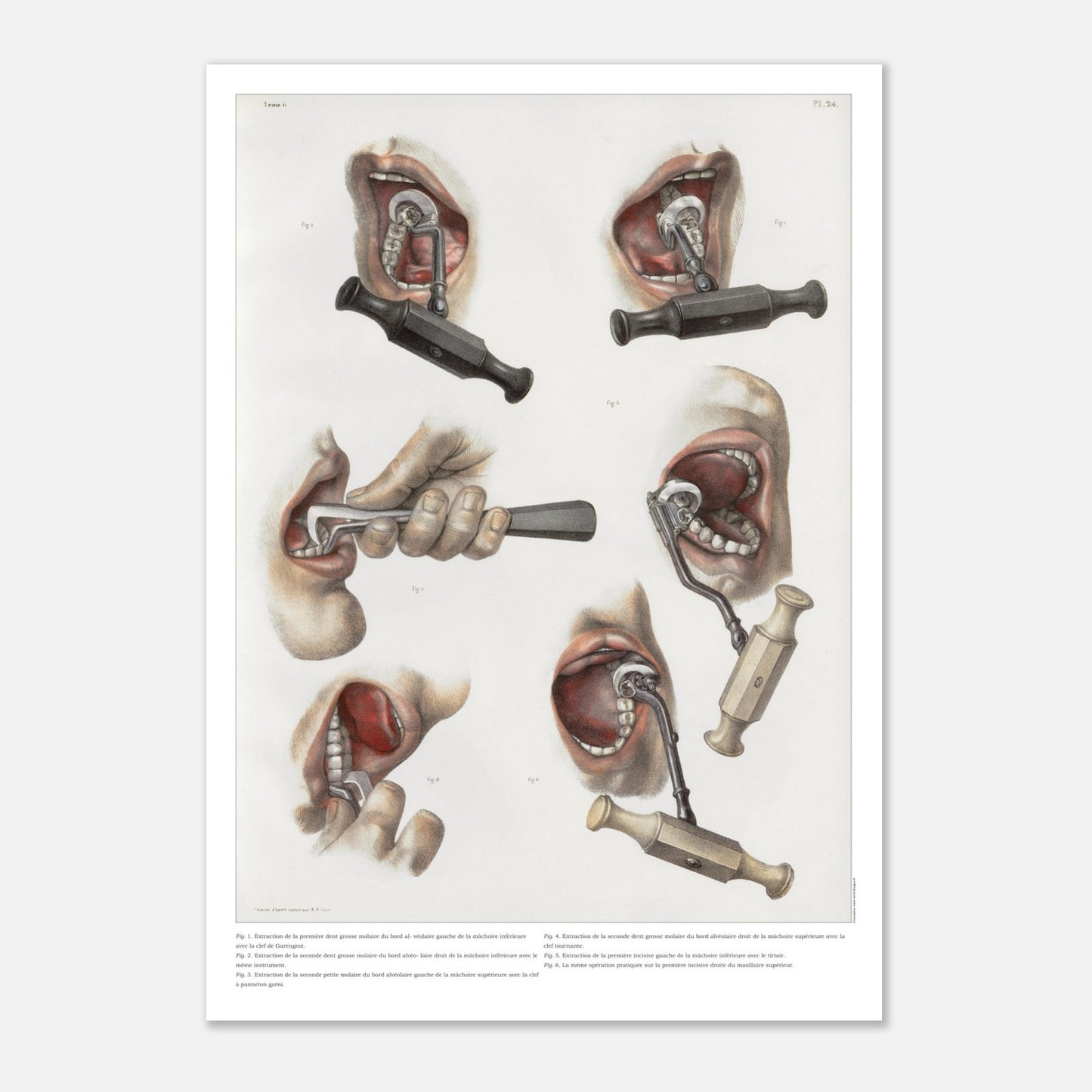 Planche d'anatomie chirurgicale - Techniques d’extraction des dents - Taille 59,4x84,1 cm (A1)