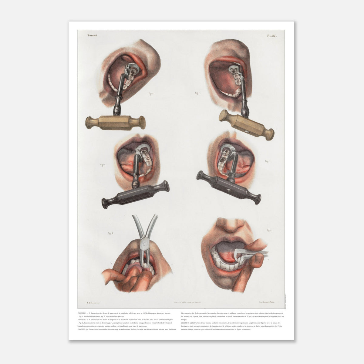 Gravure médicale ancienne sur le redressement et l'extraction dentaire (29,7x42 cm (A3)). Planche anatomique chirurgicale montrant des techniques d'extraction et de redressement de dents à l'aide d'instruments spécifiques.