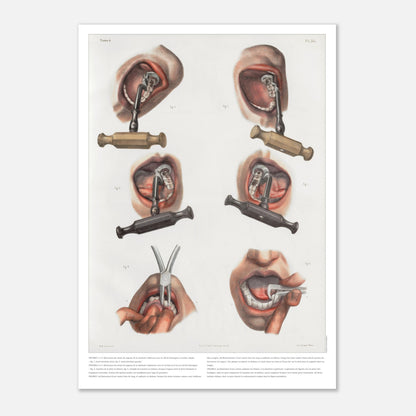 Gravure médicale ancienne sur le redressement et l'extraction dentaire (29,7x42 cm (A3)). Planche anatomique chirurgicale montrant des techniques d'extraction et de redressement de dents à l'aide d'instruments spécifiques.