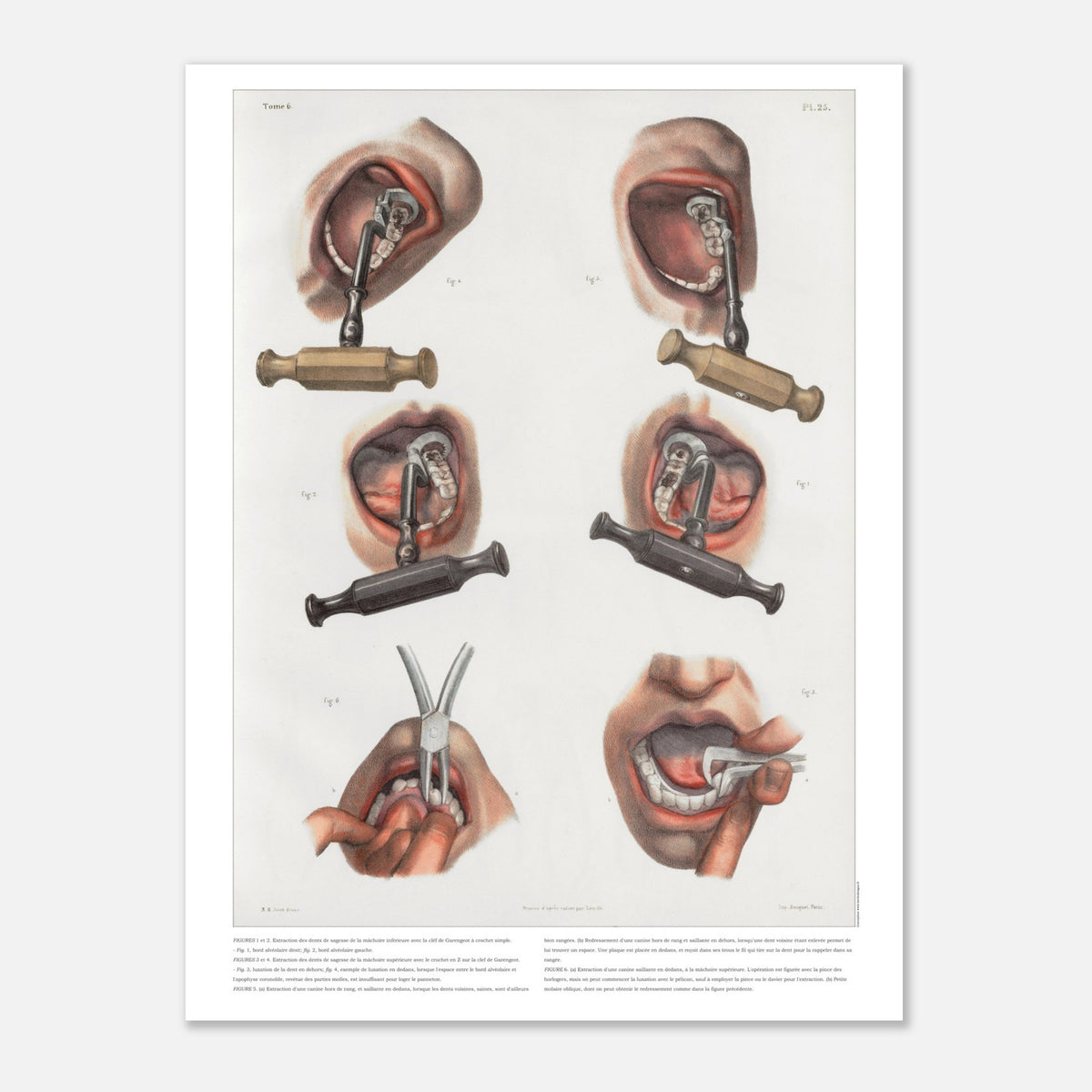 Gravure médicale ancienne sur le redressement et l'extraction dentaire (30x40 cm). Planche anatomique chirurgicale montrant des techniques d'extraction et de redressement de dents à l'aide d'instruments spécifiques.