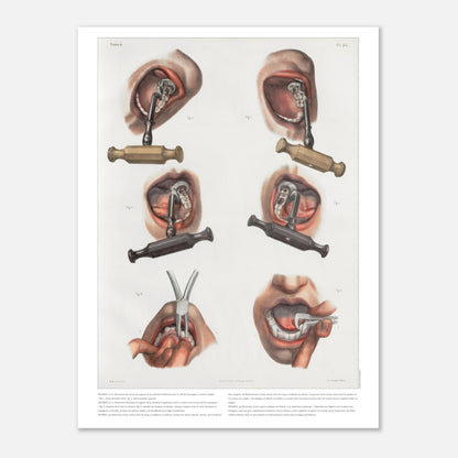 Gravure médicale ancienne sur le redressement et l'extraction dentaire (30x40 cm). Planche anatomique chirurgicale montrant des techniques d'extraction et de redressement de dents à l'aide d'instruments spécifiques.