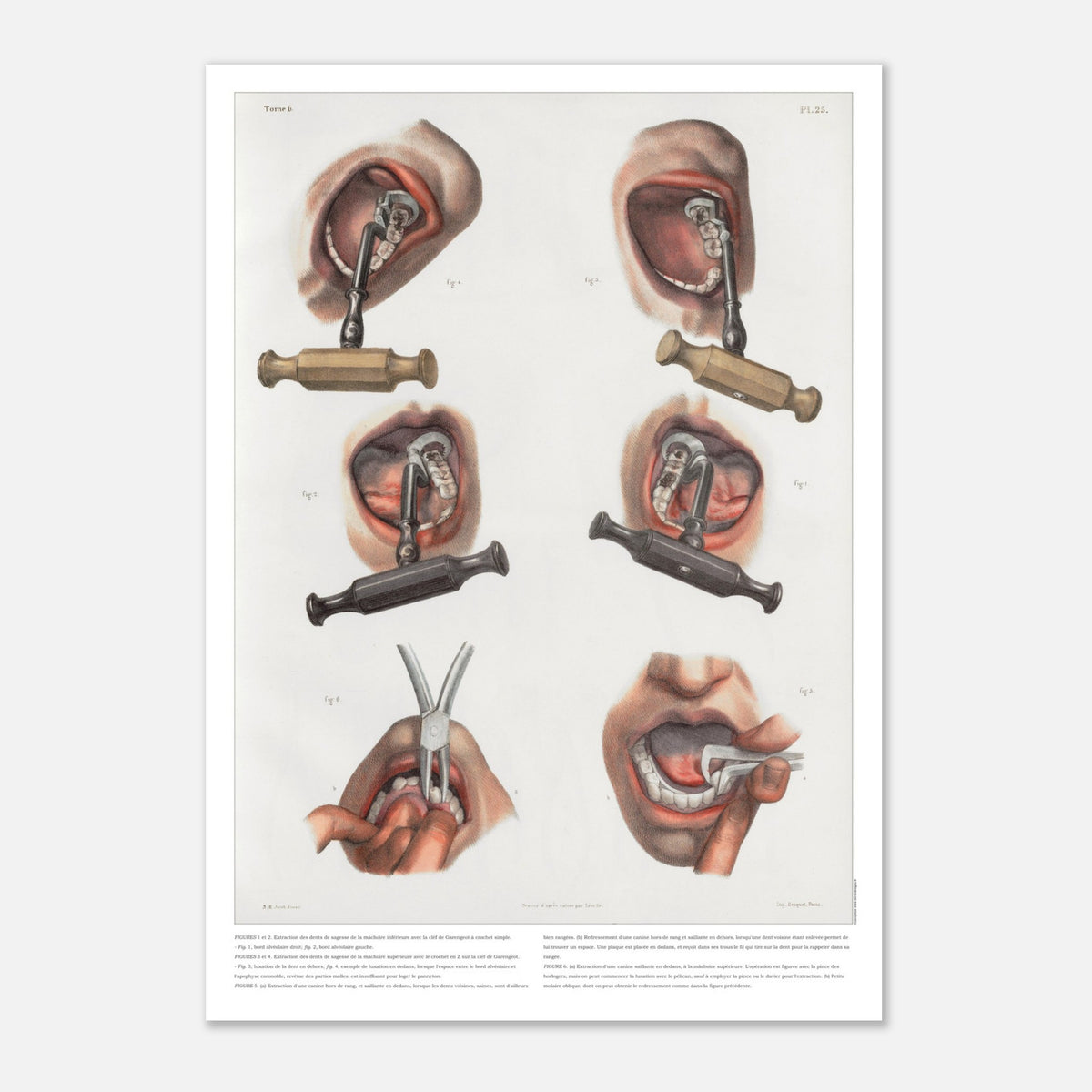 Gravure médicale ancienne sur le redressement et l'extraction dentaire (42x59,4 cm (A2)). Planche anatomique chirurgicale montrant des techniques d'extraction et de redressement de dents à l'aide d'instruments spécifiques.