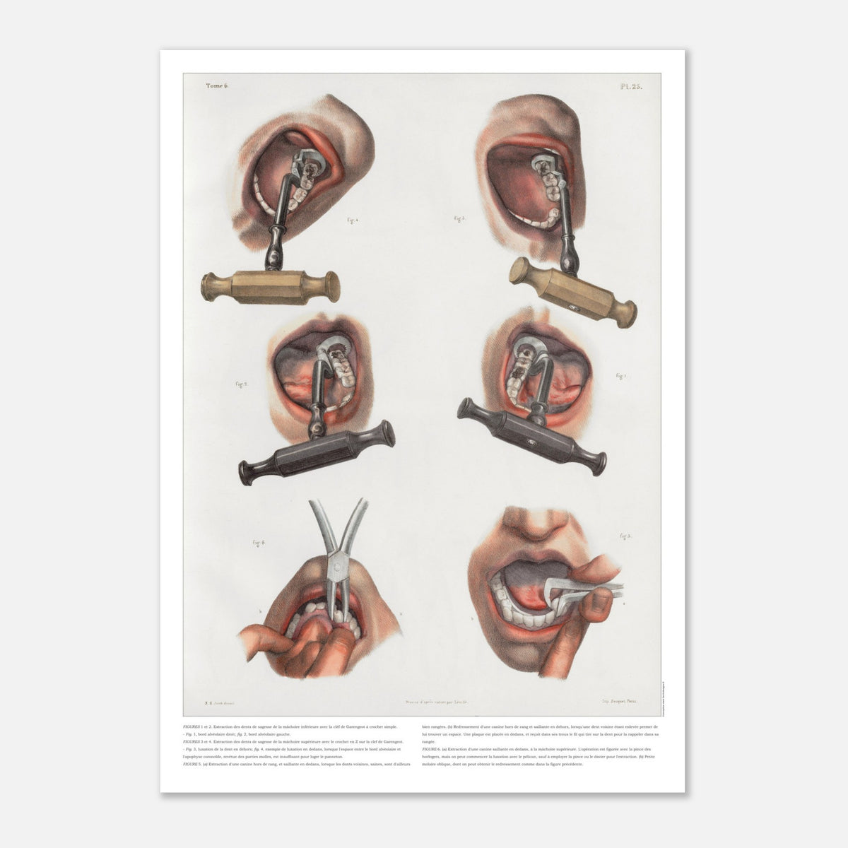 Gravure médicale ancienne sur le redressement et l'extraction dentaire (59,4x84,1 cm (A1)). Planche anatomique chirurgicale montrant des techniques d'extraction et de redressement de dents à l'aide d'instruments spécifiques.
