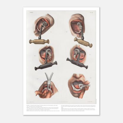 Gravure médicale ancienne sur le redressement et l'extraction dentaire (59,4x84,1 cm (A1)). Planche anatomique chirurgicale montrant des techniques d'extraction et de redressement de dents à l'aide d'instruments spécifiques.