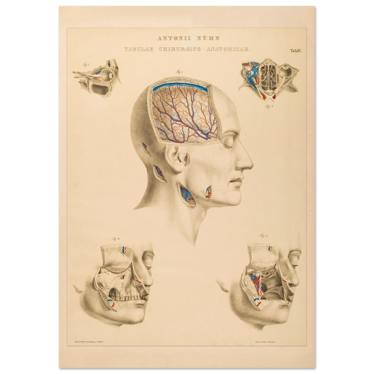 Planche chirurgicale de la tête humaine par Anton Nuhn (21x29,7 cm (A4)). Planche anatomique chirurgicale montrant des coupes de la tête humaine, illustrant les cavités crâniennes, les artères cérébrales et les structures faciales.