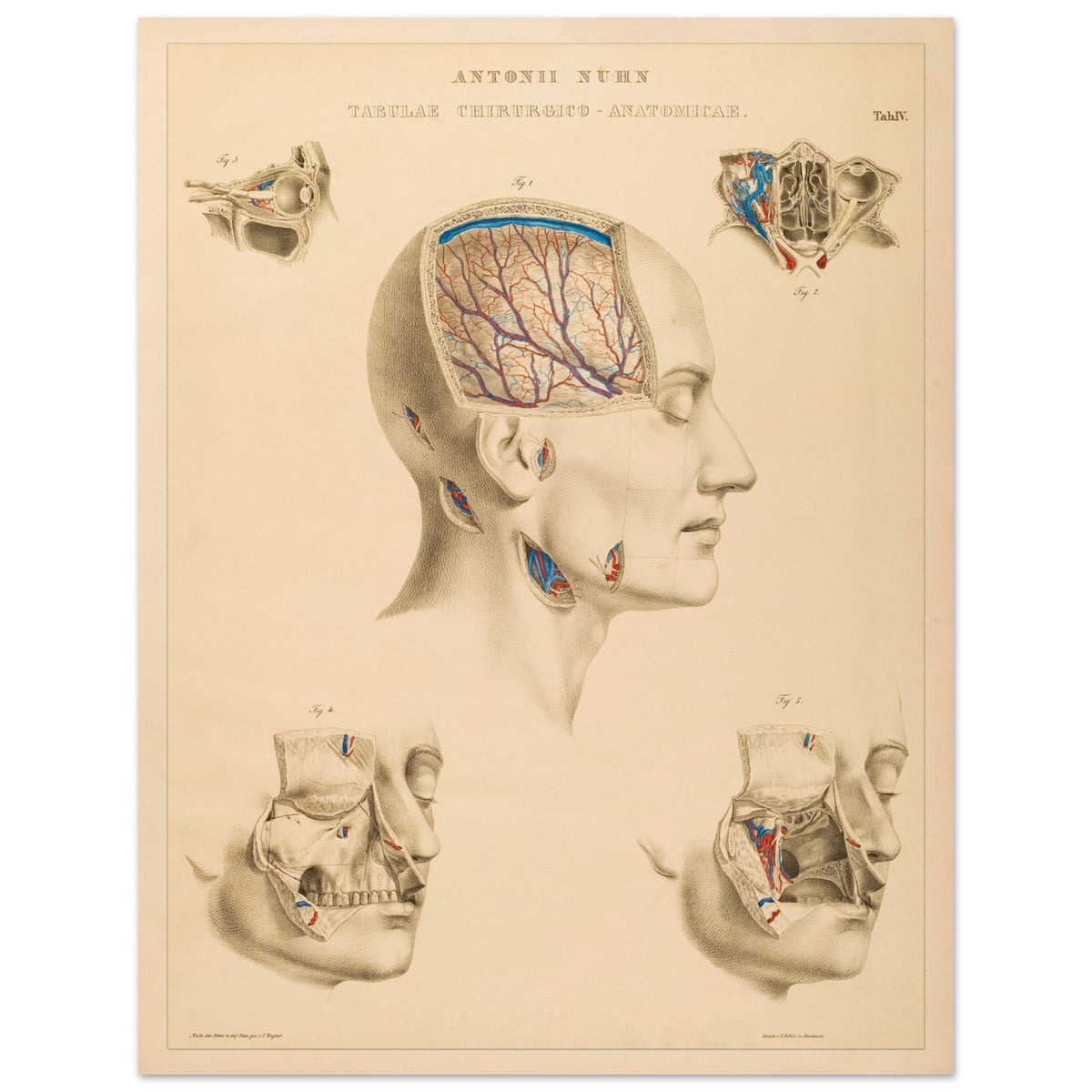 Planche chirurgicale de la tête humaine par Anton Nuhn (27x35 cm). Planche anatomique chirurgicale montrant des coupes de la tête humaine, illustrant les cavités crâniennes, les artères cérébrales et les structures faciales.