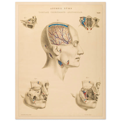 Planche chirurgicale de la tête humaine par Anton Nuhn (27x35 cm). Planche anatomique chirurgicale montrant des coupes de la tête humaine, illustrant les cavités crâniennes, les artères cérébrales et les structures faciales.