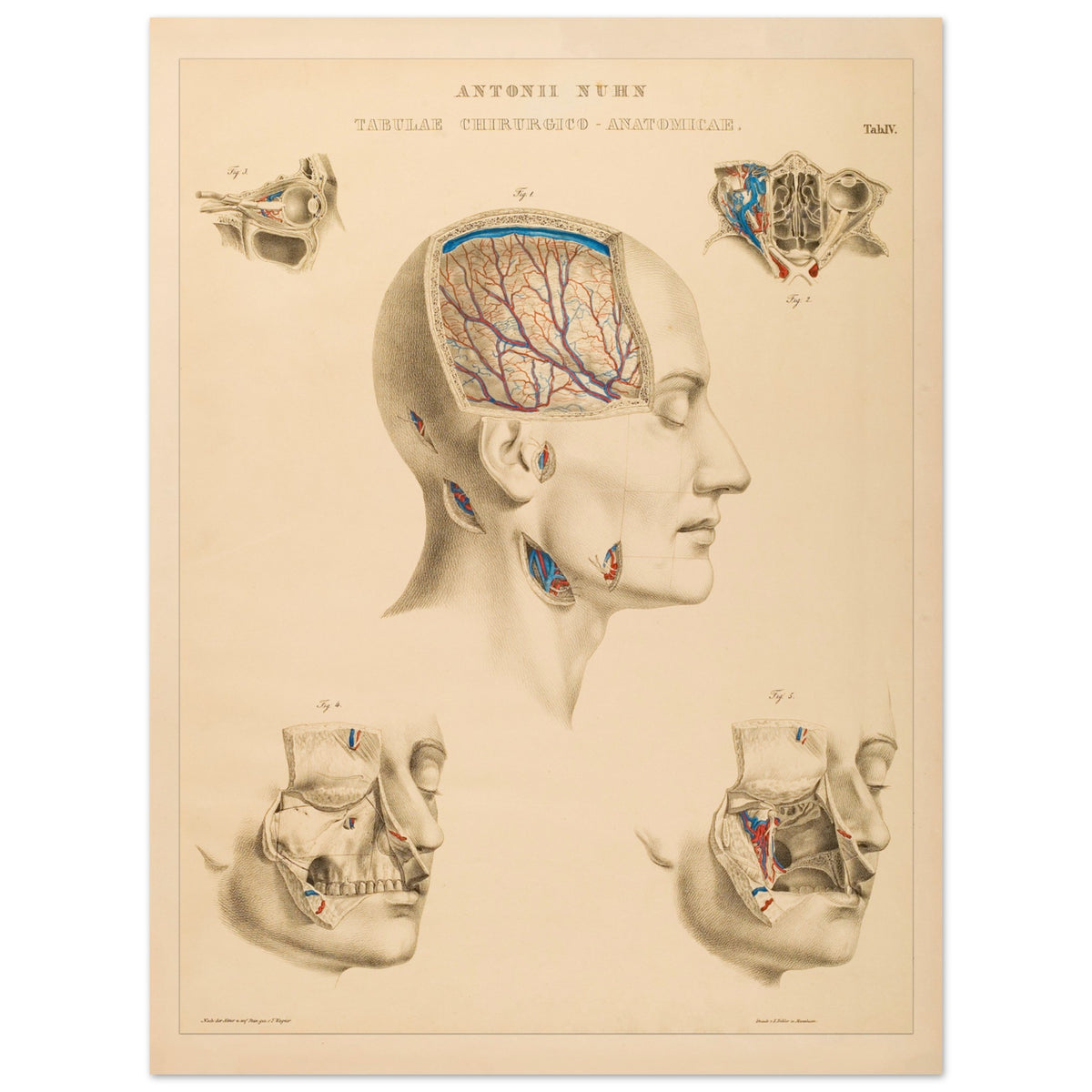 Planche chirurgicale de la tête humaine par Anton Nuhn (30x40 cm). Planche anatomique chirurgicale montrant des coupes de la tête humaine, illustrant les cavités crâniennes, les artères cérébrales et les structures faciales.