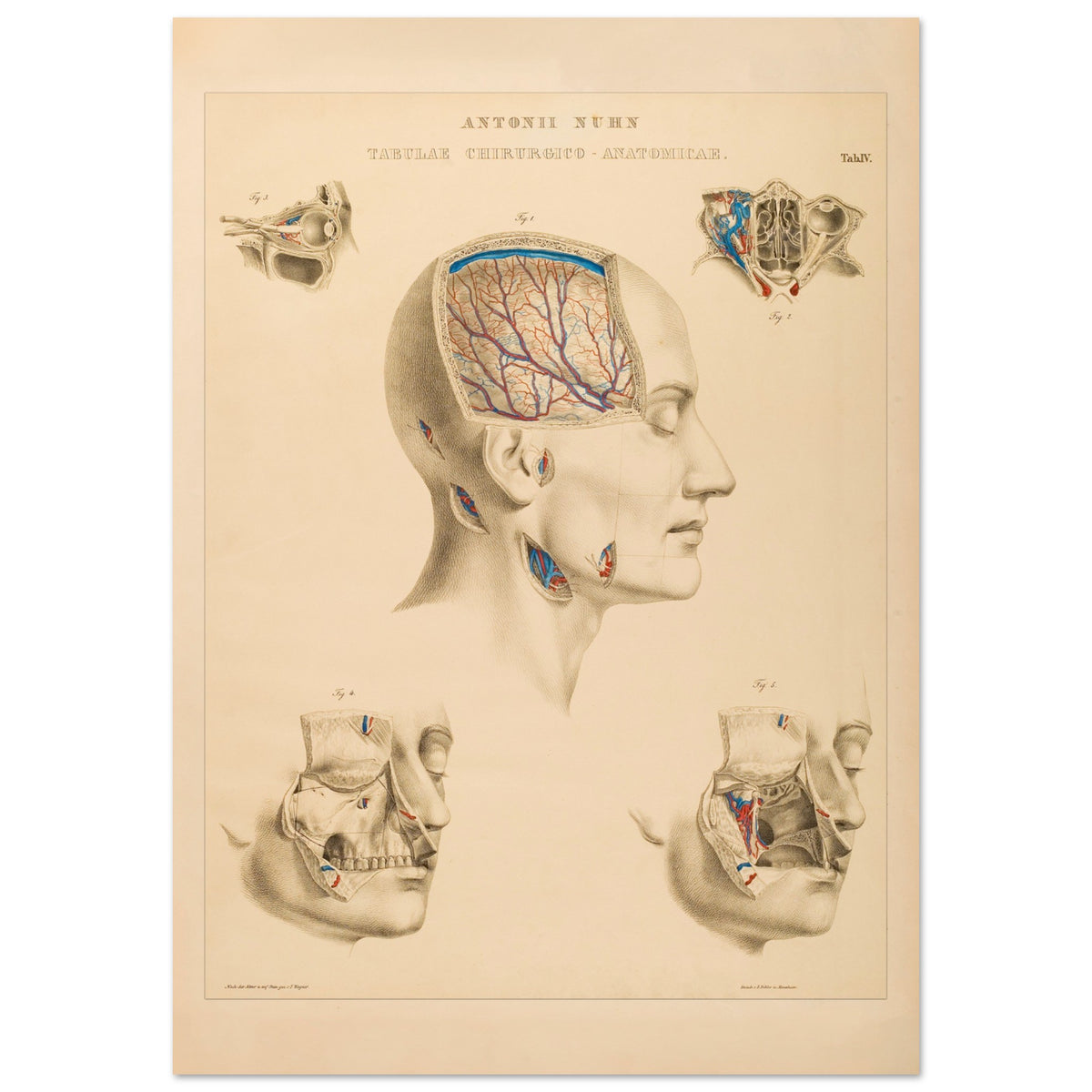 Planche chirurgicale de la tête humaine par Anton Nuhn (59,4x84,1 cm (A1)). Planche anatomique chirurgicale montrant des coupes de la tête humaine, illustrant les cavités crâniennes, les artères cérébrales et les structures faciales.