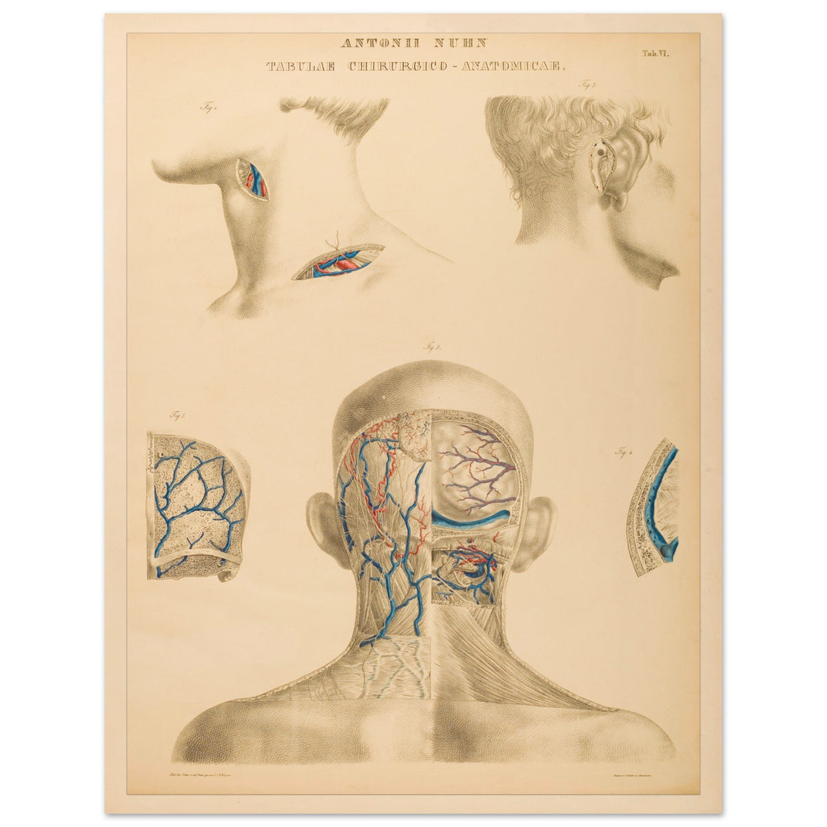 Planche anatomique occipitale et mastoïdienne Anton Nuhn (27x35 cm). Planche anatomique chirurgicale de la région occipitale et mastoïdienne, montrant les structures vasculaires et osseuses, par Anton Nuhn.