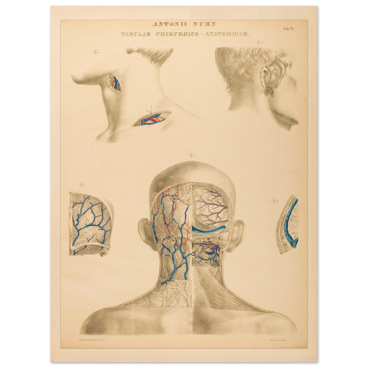 Planche anatomique occipitale et mastoïdienne Anton Nuhn (30x40 cm). Planche anatomique chirurgicale de la région occipitale et mastoïdienne, montrant les structures vasculaires et osseuses, par Anton Nuhn.