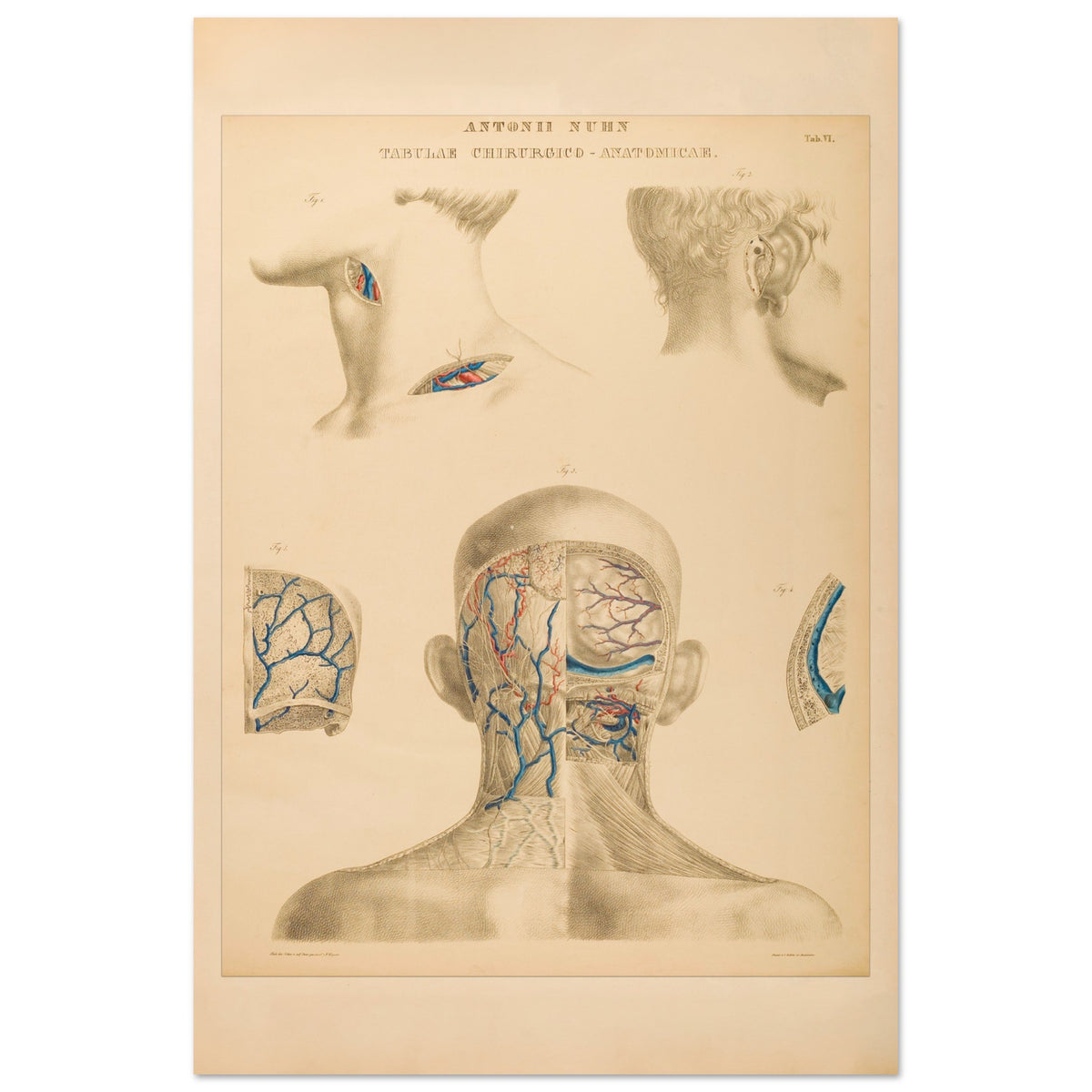 Planche anatomique occipitale et mastoïdienne Anton Nuhn (40x60 cm). Planche anatomique chirurgicale de la région occipitale et mastoïdienne, montrant les structures vasculaires et osseuses, par Anton Nuhn.