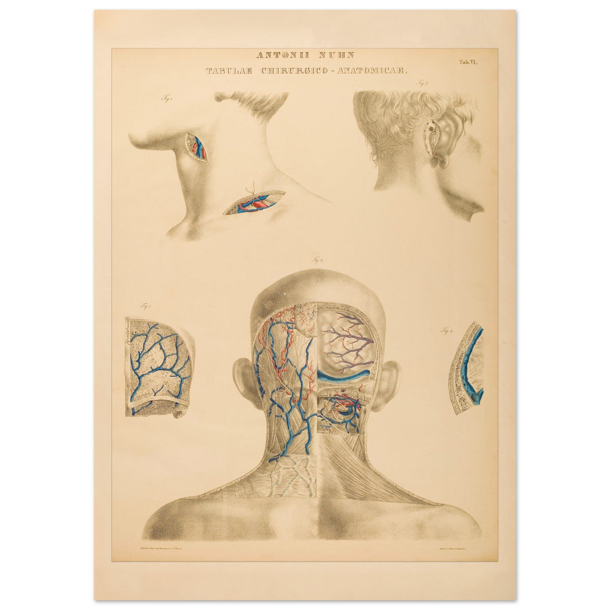 Planche anatomique occipitale et mastoïdienne Anton Nuhn (50x70 cm). Planche anatomique chirurgicale de la région occipitale et mastoïdienne, montrant les structures vasculaires et osseuses, par Anton Nuhn.
