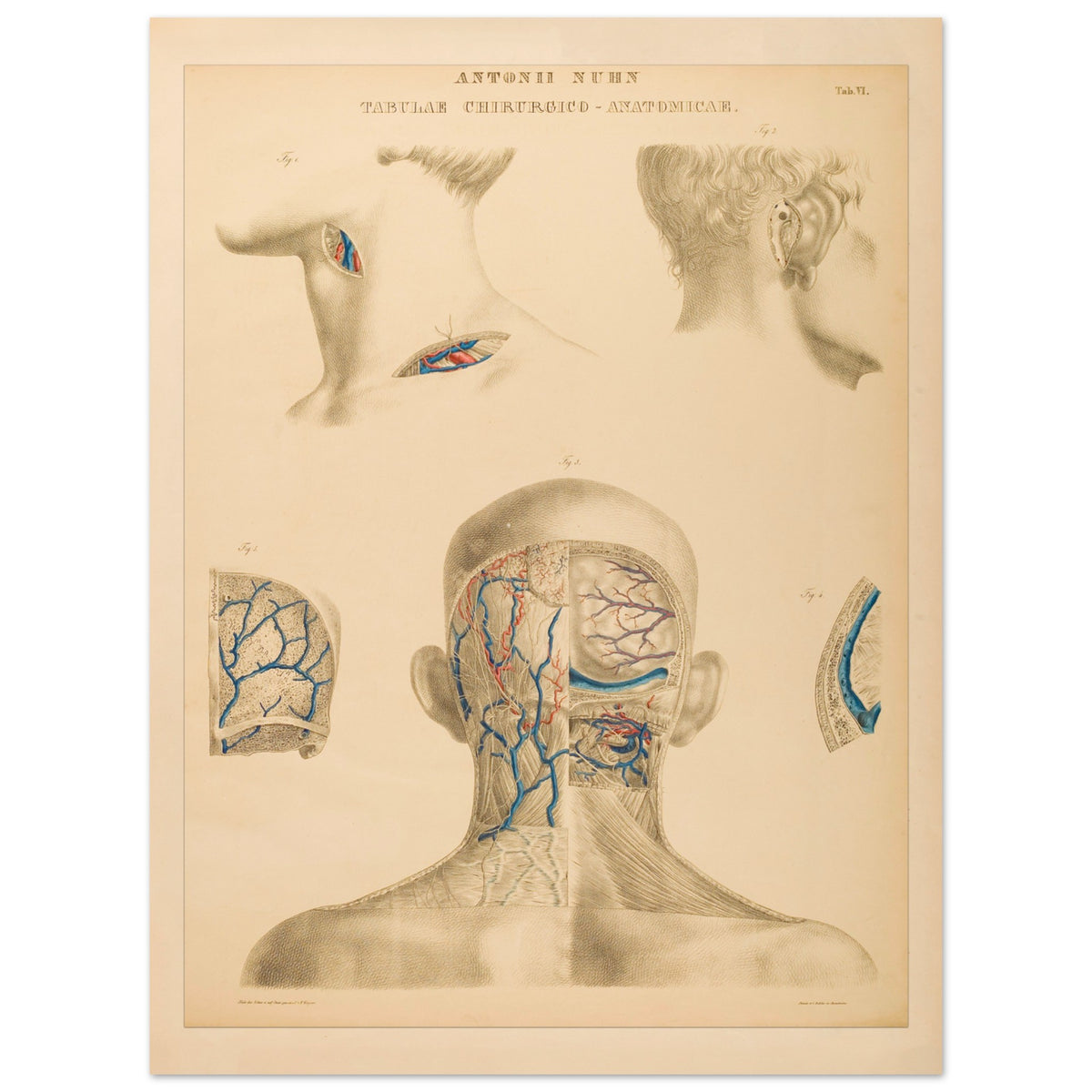 Planche anatomique occipitale et mastoïdienne Anton Nuhn (60x80 cm). Planche anatomique chirurgicale de la région occipitale et mastoïdienne, montrant les structures vasculaires et osseuses, par Anton Nuhn.