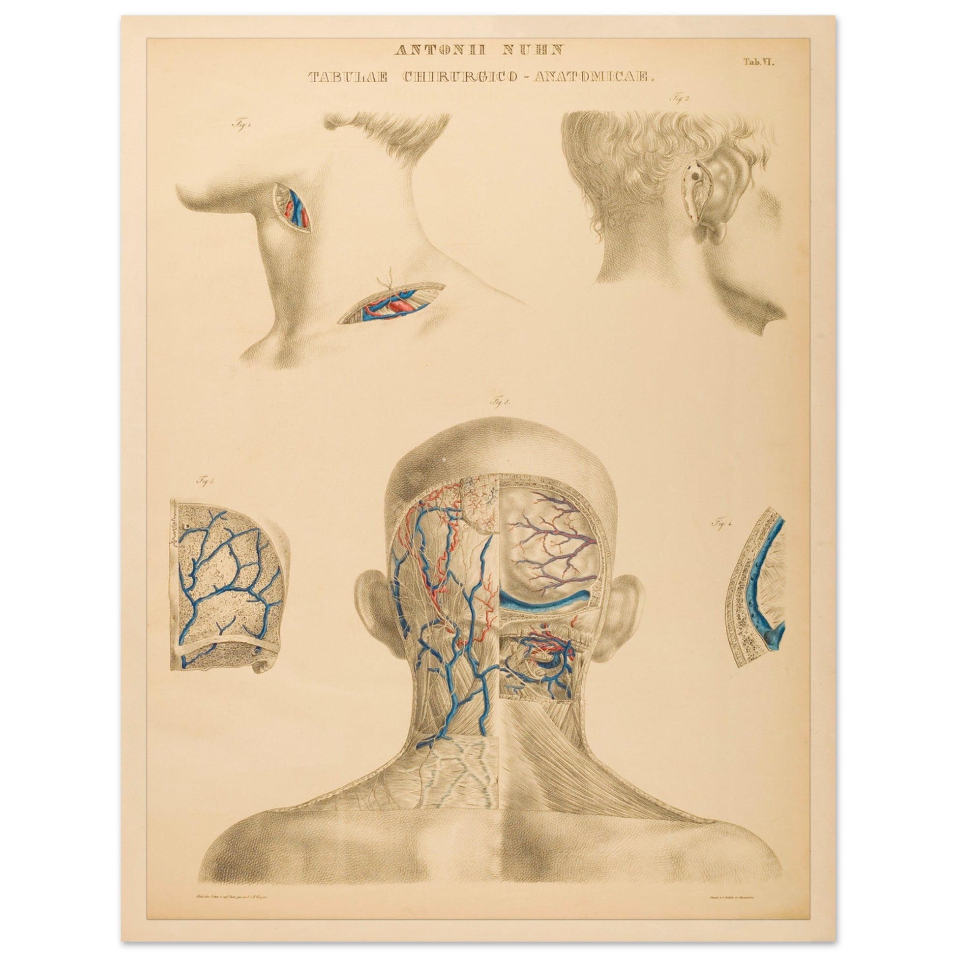 Planche anatomique : Techniques chirurgicales de la région occipitale et mastoïdienne par Anton Nuhn - Taille 27x35 cm
