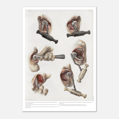 Planche médicale ancienne d'odontologie et extraction dentaire (29,7x42 cm (A3)). Planche anatomique chirurgicale illustrant diverses techniques et instruments pour l'extraction de dents.