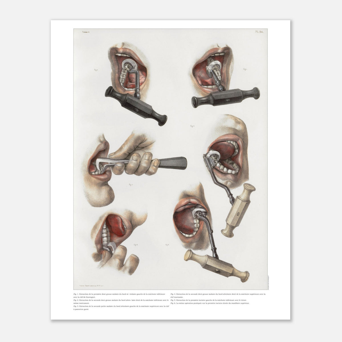 Planche médicale ancienne d'odontologie et extraction dentaire (40x50 cm). Planche anatomique chirurgicale illustrant diverses techniques et instruments pour l'extraction de dents.