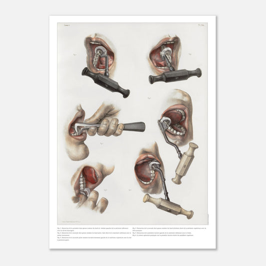 Planche médicale ancienne d'odontologie et extraction dentaire (50x70 cm). Planche anatomique chirurgicale illustrant diverses techniques et instruments pour l'extraction de dents.