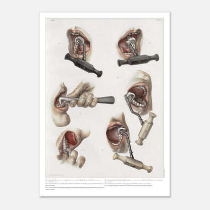 Planche médicale ancienne d'odontologie et extraction dentaire (59,4x84,1 cm (A1)). Planche anatomique chirurgicale illustrant diverses techniques et instruments pour l'extraction de dents.