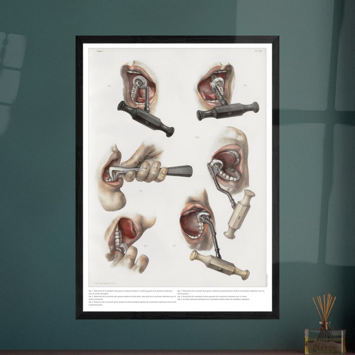 Planche médicale ancienne d'odontologie et extraction dentaire. Planche anatomique chirurgicale illustrant diverses techniques et instruments pour l'extraction de dents.