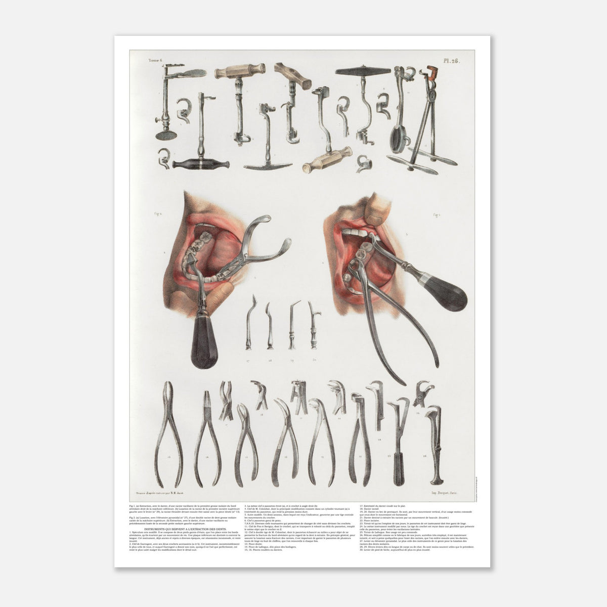 Planche d'odontologie ancienne et instruments dentaires (29,7x42 cm (A3)). Planche anatomique chirurgicale présentant de nombreux instruments dentaires et deux vues d'une bouche en cours de traitement.