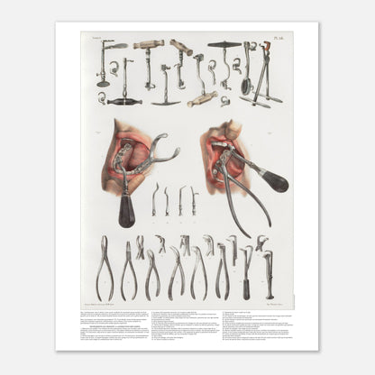 Planche d'odontologie ancienne et instruments dentaires (40x50 cm). Planche anatomique chirurgicale présentant de nombreux instruments dentaires et deux vues d'une bouche en cours de traitement.