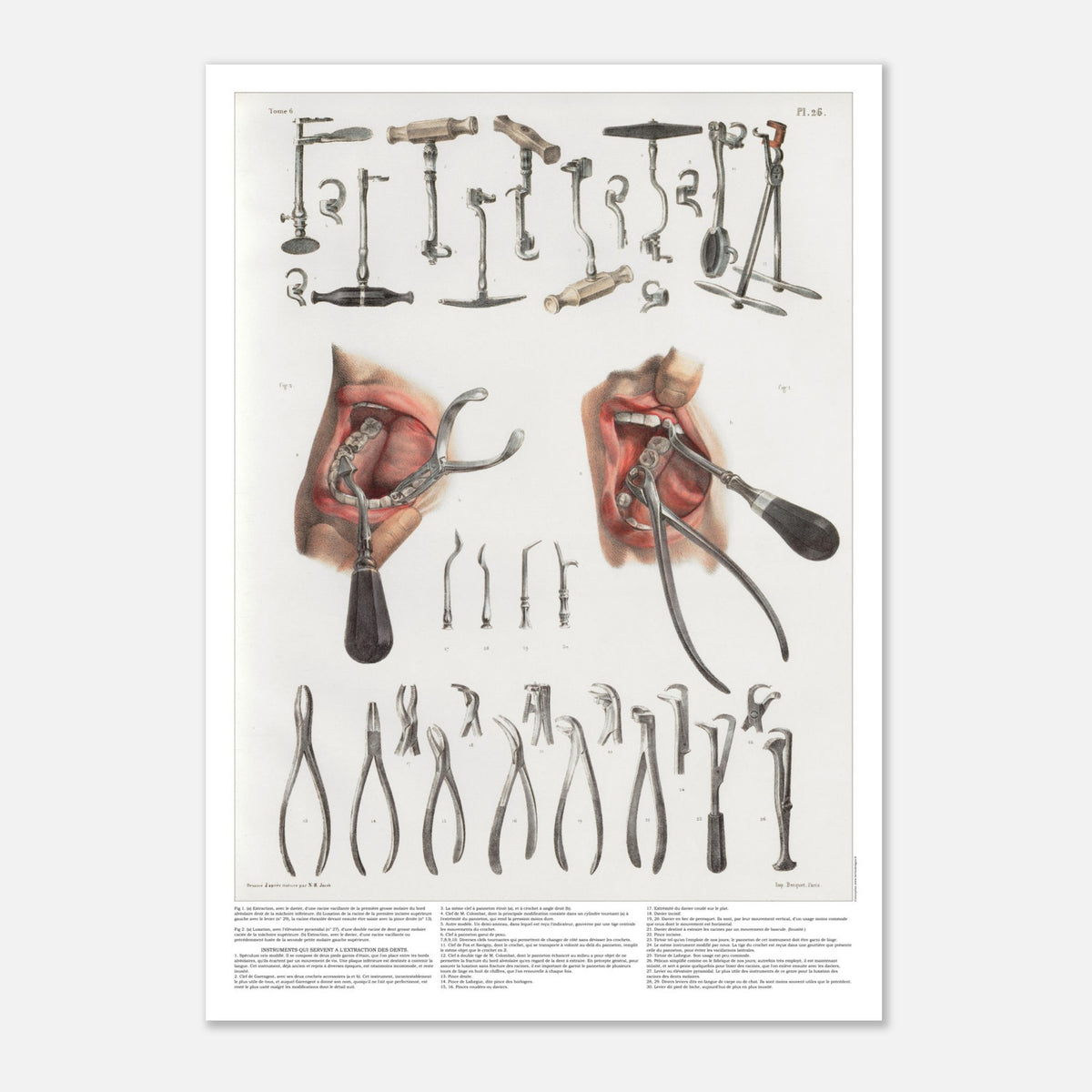 Planche d'odontologie ancienne et instruments dentaires (42x59,4 cm (A2)). Planche anatomique chirurgicale présentant de nombreux instruments dentaires et deux vues d'une bouche en cours de traitement.